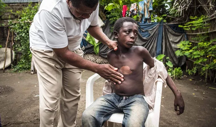 Un médecin comorien d’Action Damien recherche des symptômes de la lèpre sur un jeune patient.